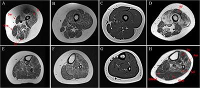 A Recurrent Pathogenic Variant of INPP5K Underlies Autosomal Recessive Congenital Muscular Dystrophy With Cataracts and Intellectual Disability: Evidence for a Founder Effect in Southern Italy